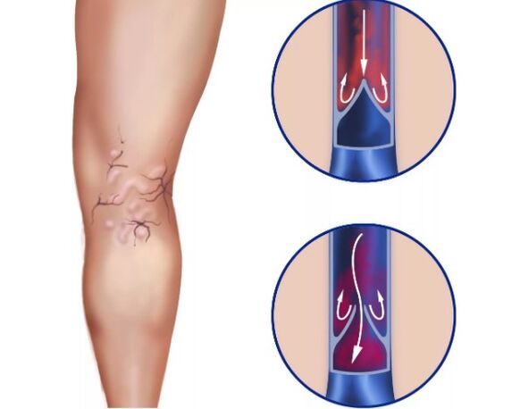 Thrombose