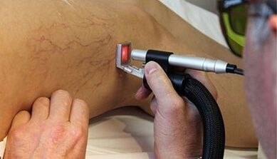 Laserbehandlung von Krampfadern